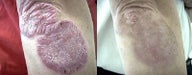 Psoriasis treatment to the arm