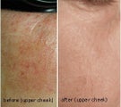 Laser therapy to correct melasma