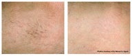 Spider veins on the leg treated with laser therapy