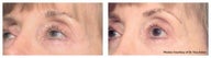 Laser skin resurfacing around the eyes