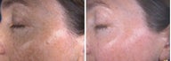 IPL for hyperpigmentation and freckles on face