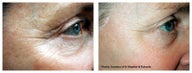 Crow's feet treated with pulsed dye laser