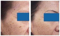 Age spot removal with laser therapy