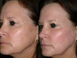 Juvia fractional CO2 resurfacing