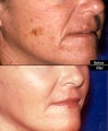 CO2 Laser Resurfacing