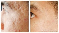 Acne scars and pock mark treatment by laser skin resurfacing