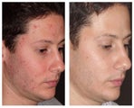 Laser acne treatment