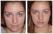 Acne treatment by laser skin resurfacing