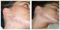 Face acne treatment by laser skin resurfacing