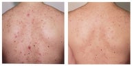 Back acne laser treatment