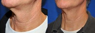 Laser Treatment
