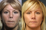 CO2 Full Face Laser
