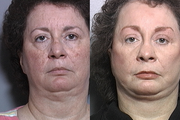CO2 Full Face Laser