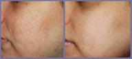 Acne scar smoothing by laser treatment