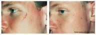 Scar treatment by laser skin resurfacing