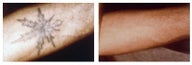Tattoo Removal by laser skin resurfacing