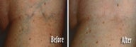 Varicose vein treatment by laser
