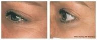 Laser skin resurfacing around the eyes