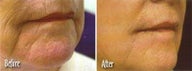 Laser skin resurfacing to get rid of facial lines and wrinkles