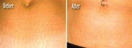 Stretchmark treatment by laser skin resurfacing