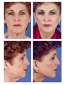 Total facial plastic surgery, age 56