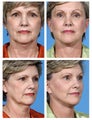 Complete face makeover, age 56