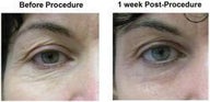 ActiveFX laser treatment for facial lines