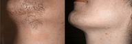 Laser Hair Removal