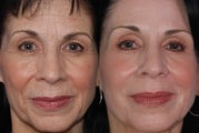 Derma K and Fraxel Repair Laser Treatment of Wrinkles