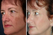Laser resurfacing