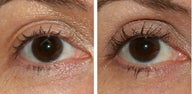 Latisse Before & After