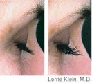 Latisse, before and after