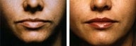 Lip augmentation