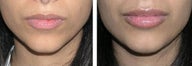 Lip Augmentation