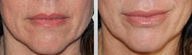 Lip Augmentation