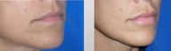 Lip Augmentation