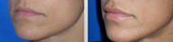 Lip Augmentation