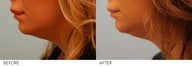 Lip Reduction