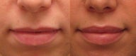 Lip Augmentation with Juvederm