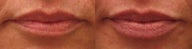 Lip Augmentation with Restylane
