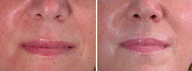 Lip Augmentation