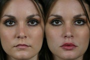 Juvederm Ultra Plus