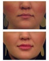 Injectable Filler