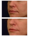 Injectable Filler