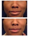 Injectable Filler