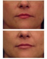 Injectable Filler