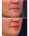 Injectable Filler