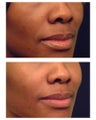 Injectable Filler