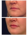 Injectable Filler