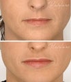 Resylane lip augmentation 1.0 ml